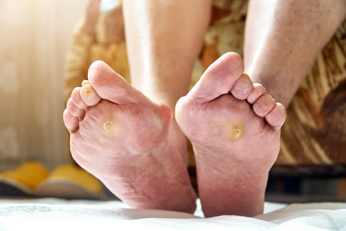 Feet With Issues- Calluses And Long Toenails And Blisters.